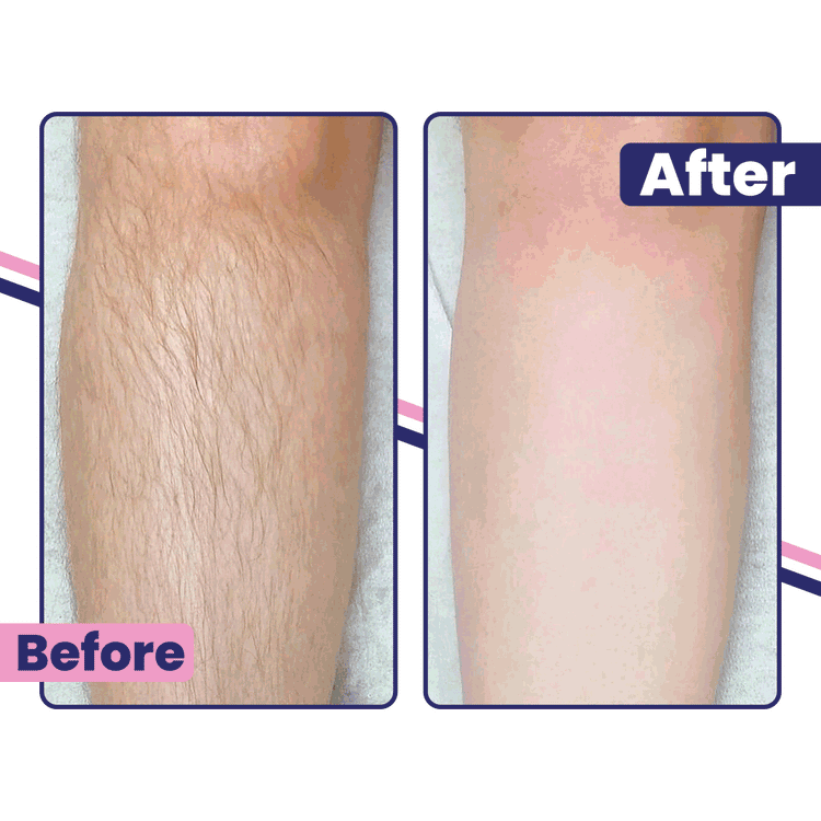 Babyverse SE5 IPL Hair Removal Device — Ice-Cool Technology | 990,000 Flashes | Salon-Grade Results at Home
