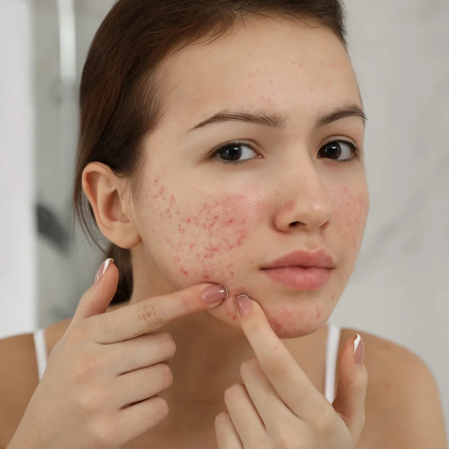acne care