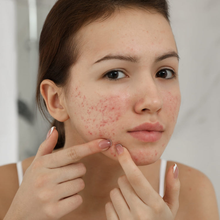 Acne Care