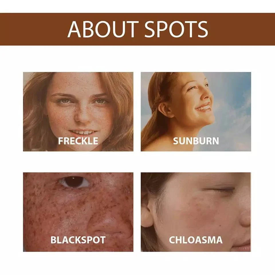 Skin spot guide with photos labeled freckle, sunburn, blackspot, and chloasma
