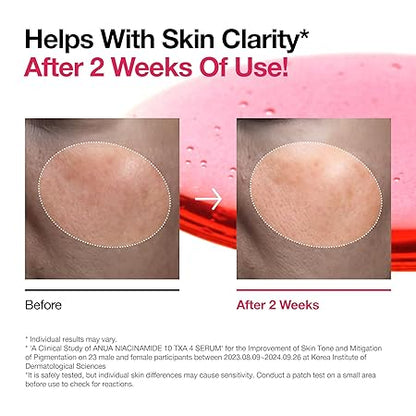 Before and after skin clarity on cheeks after using serum
