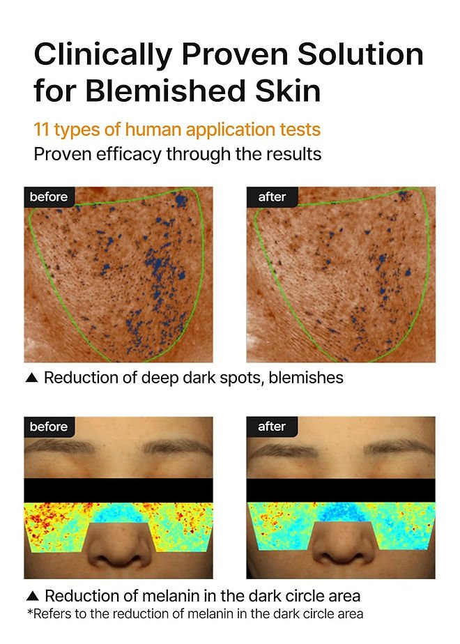Blemished-skin face cream infographic with reduction charts and before-and-after panels
