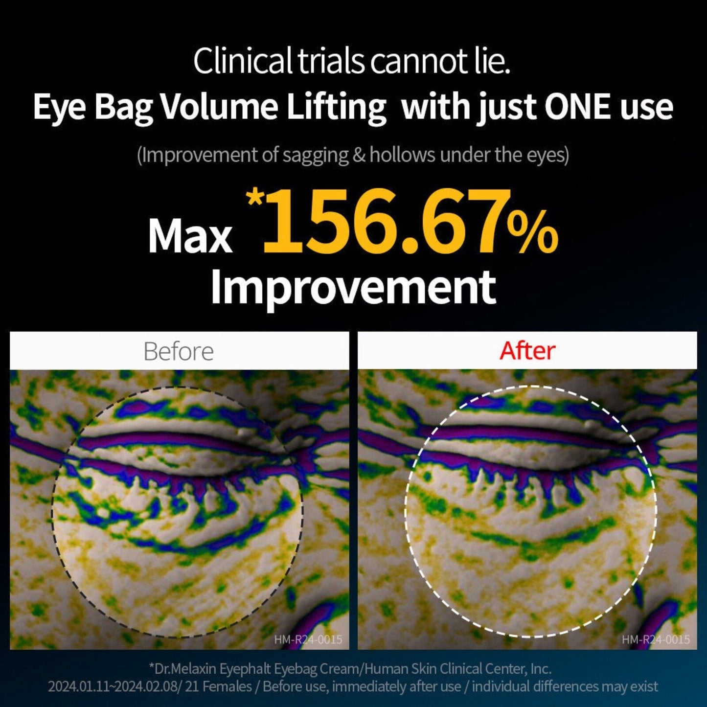 Eye bag volume lifting infographic with before and after under-eye circle views