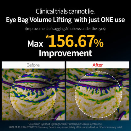 Eye bag volume lifting infographic with before and after under-eye circle views