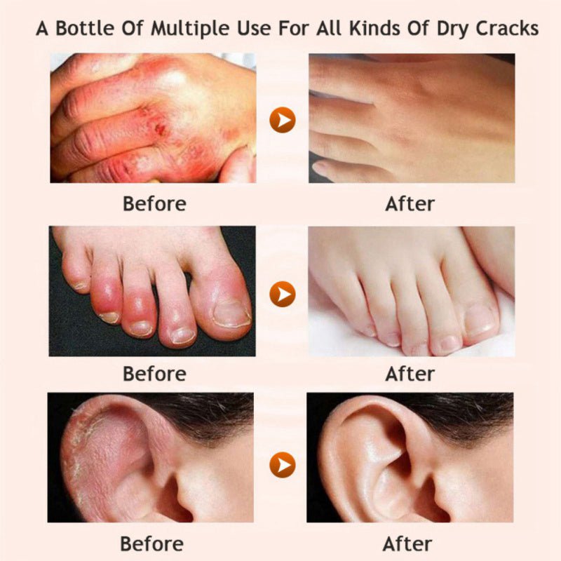 Before-and-after collage showing dry cracks improved on feet, multiple panels
