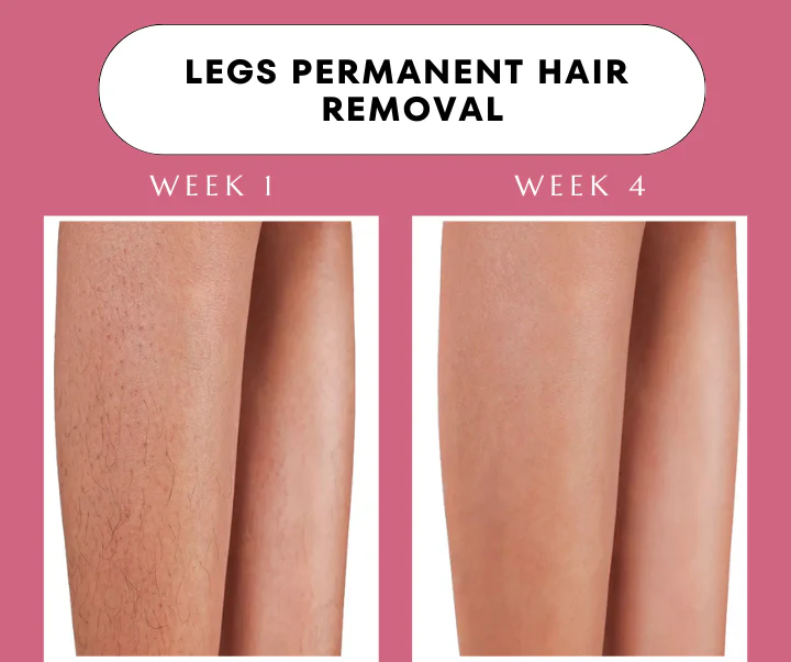 Babyverse SE5 IPL Hair Removal Device — Ice-Cool Technology | 990,000 Flashes | Salon-Grade Results at Home