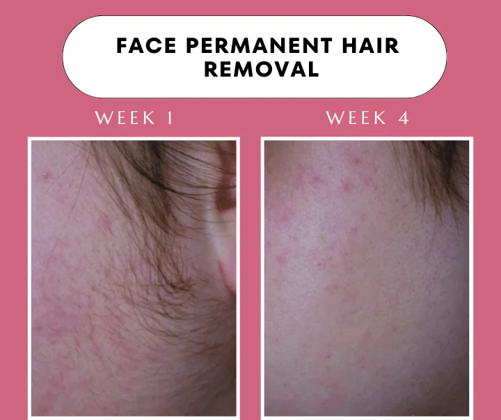 Babyverse SE5 IPL Hair Removal Device — Ice-Cool Technology | 990,000 Flashes | Salon-Grade Results at Home