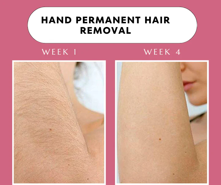 Babyverse SE5 IPL Hair Removal Device — Ice-Cool Technology | 990,000 Flashes | Salon-Grade Results at Home
