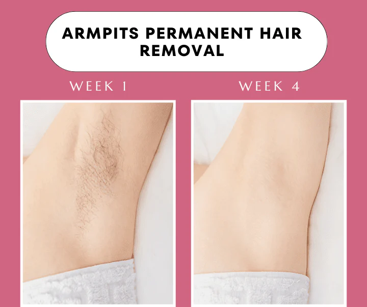 Babyverse SE5 IPL Hair Removal Device — Ice-Cool Technology | 990,000 Flashes | Salon-Grade Results at Home