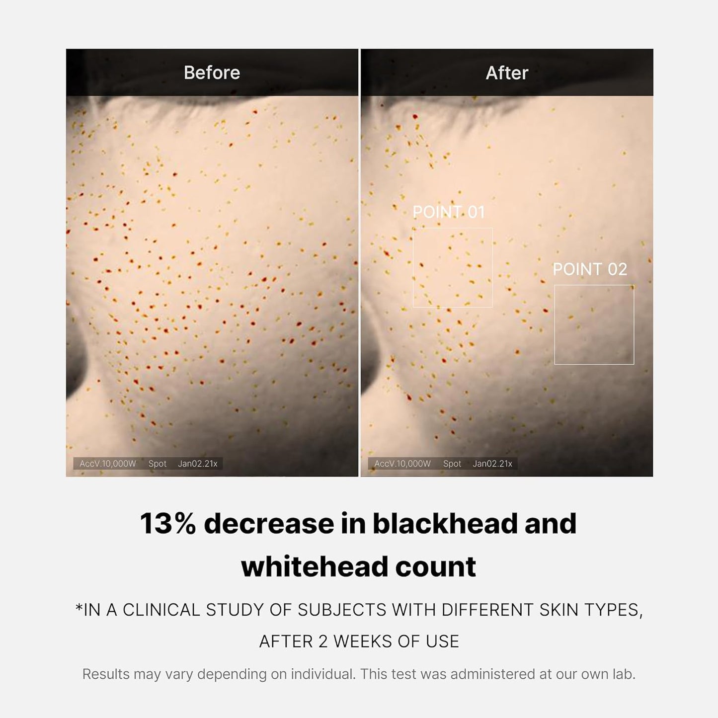 Before-and-after results graphic with fewer blackhead and whitehead spots